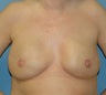 Breast Reconstruction