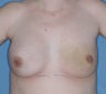 Breast Reconstruction