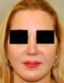 Revision Rhinoplasty