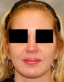 Revision Rhinoplasty