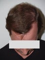 Hair Transplant