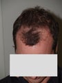 Hair Transplant