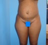 45 year old female treated for excess skin and fat of the abdomen