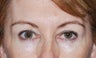 Botox