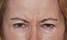 Botox
