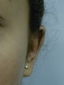 Otoplasty