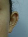 Otoplasty