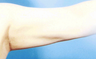 Arm Liposuction