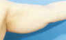 Arm Liposuction