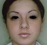 Female patient who underwent ear surgery