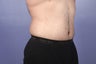 37 yr old weight loss patient