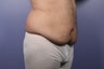 37 yr old weight loss patient