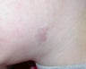 V Beam treatment of a child's scar