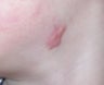 V Beam treatment of a child's scar