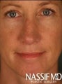 Female Revision Rhinoplasty