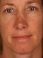Female Revision Rhinoplasty