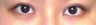 Bilateral Asian Eyelid Surgery
