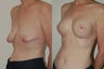 Breast Augmentation and Lift