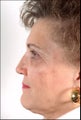 Rhinoplasty