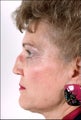Rhinoplasty