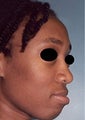 23 year old female patient