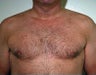 Adult Male Treated for Male Breast Reduction