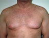 Adult Male Treated for Male Breast Reduction