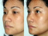 Asian Revision Rhinoplasty – Pollybeak Deformity