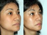 Asian Revision Rhinoplasty – Pollybeak Deformity