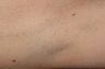 Laser Hair Removal