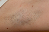 Laser Hair Removal