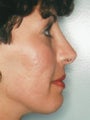 Revision Rhinoplasty