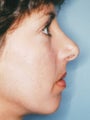 Revision Rhinoplasty