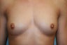 Gummy Bear Breast Implant