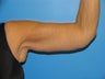 60 yr old woman with Brachioplasty