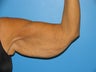 60 yr old woman with Brachioplasty