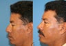 male rhinoplasty