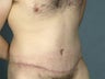 Male Abdominoplasty