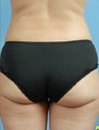 truSculpt