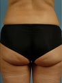 truSculpt