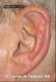 Ear Reconstruction / Mohs Reconstruction