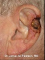 Ear Reconstruction / Mohs Reconstruction