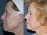 Before & After V-Beam Laser