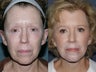 Before & After V-Beam Laser