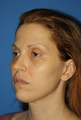 Ulthera