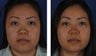 Female Non-Surgical Rhinoplasty