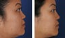 Female Non-Surgical Rhinoplasty
