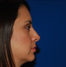 Chin Augmentation