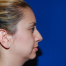 Chin Augmentation