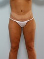 Body Lift